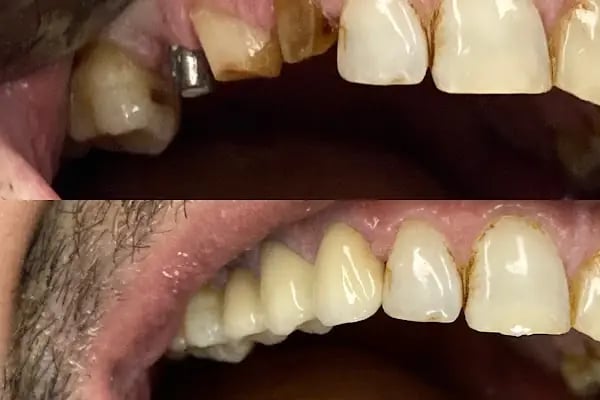 Diş Hekimi Tuğçe ÖZKAN - Elmalı Dent Diş Polikliniği - Resim 11