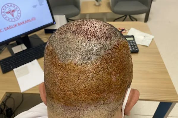 Transes Hair Transplant - Resim 7