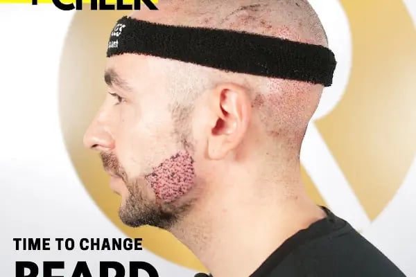 Transes Hair Transplant - Resim 20
