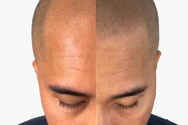 Transes Hair Transplant - Resim 16
