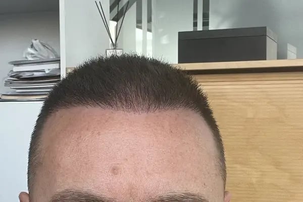 Transes Hair Transplant - Resim 6