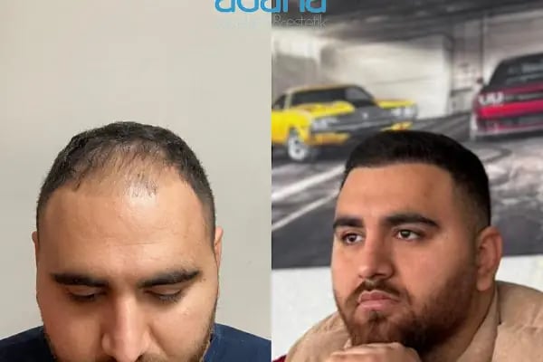 Adana Saç Ekim - Resim 13