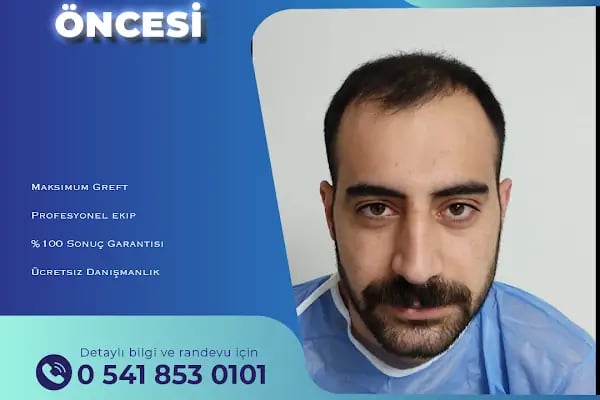 Adana Saç Ekim - Resim 16