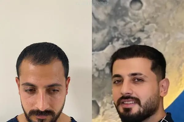 Adana Saç Ekim - Resim 10