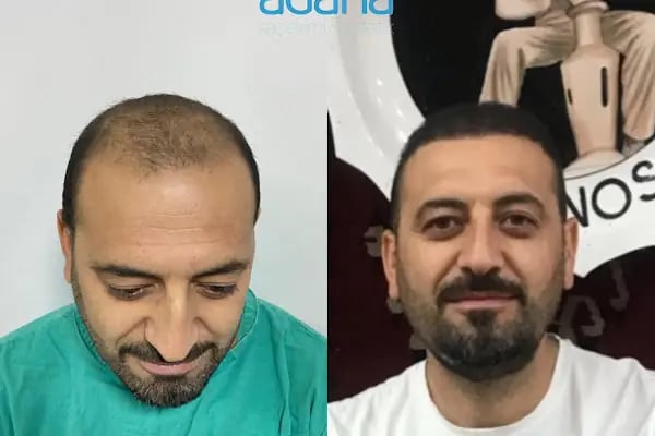 Adana Saç Ekim - Resim 14