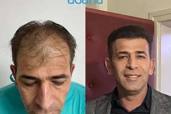 Adana Saç Ekim - Resim 20