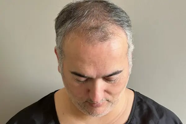 İzmir saç ekim merkezi Maxhaırclınıc Saç Ekim İzmir - Resim 16