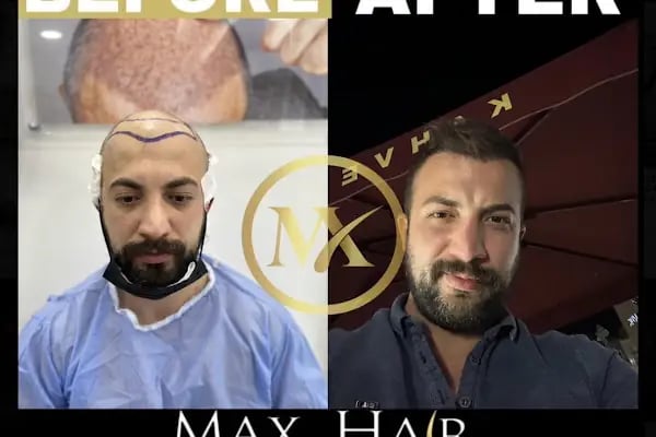 İzmir saç ekim merkezi Maxhaırclınıc Saç Ekim İzmir - Resim 13