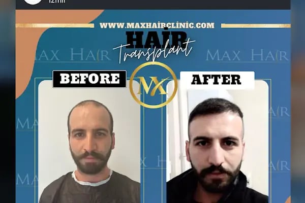İzmir saç ekim merkezi Maxhaırclınıc Saç Ekim İzmir - Resim 14