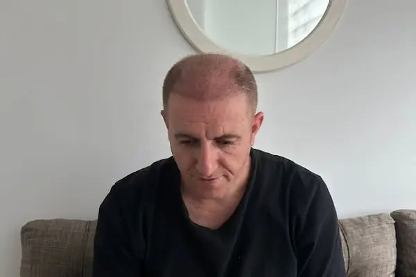 İzmir saç ekim merkezi Maxhaırclınıc Saç Ekim İzmir - Resim 8