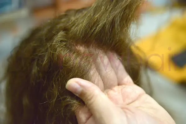 Newhair Bakırköy, Protez saç, Saç Protezi, Saç Ekimi, Kemoterapi, Hair Replacement, Toupee - Resim 18