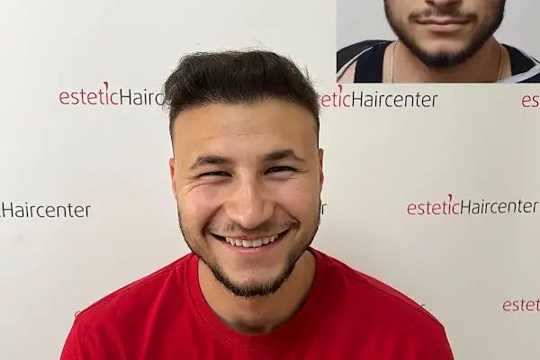 Estetichaircenter Saç Ekimi Saç Simülasyonu Bursa - Resim 17