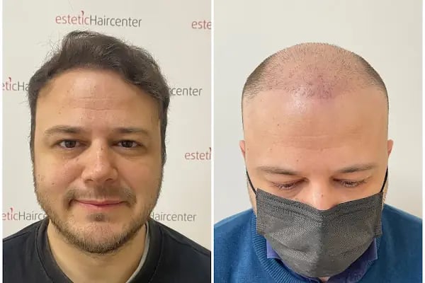 Estetichaircenter Saç Ekimi Saç Simülasyonu Bursa - Resim 15