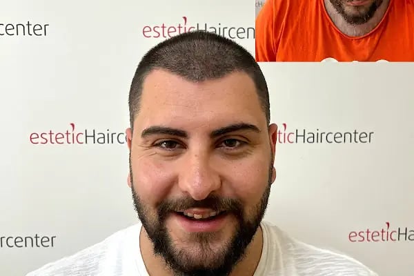 Estetichaircenter Saç Ekimi Saç Simülasyonu Bursa - Resim 14