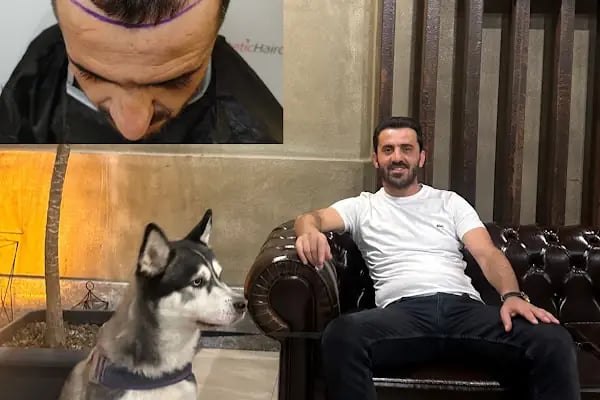 Estetichaircenter Saç Ekimi Saç Simülasyonu Bursa - Resim 6