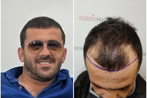 Estetichaircenter Saç Ekimi Saç Simülasyonu Bursa - Resim 1