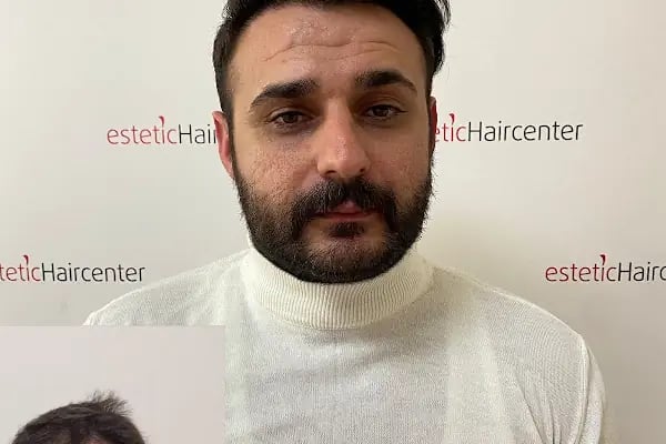 Estetichaircenter Saç Ekimi Saç Simülasyonu Bursa - Resim 16