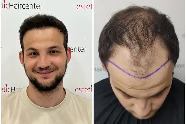 Estetichaircenter Saç Ekimi Saç Simülasyonu Bursa - Resim 19