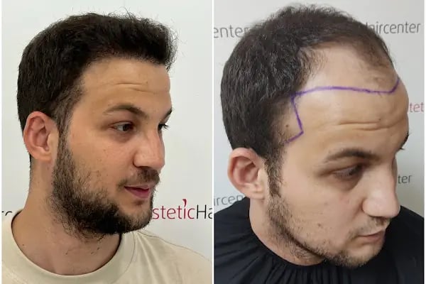Estetichaircenter Saç Ekimi Saç Simülasyonu Bursa - Resim 20