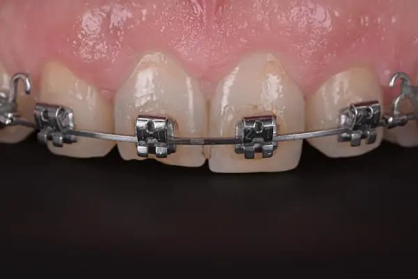 Özel Balıkesir Dentmaks Ağız ve Diş Sağlığı Polikliniği - Hastanesi / invisalign - implant - lamine - Resim 19