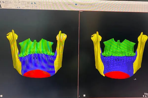 Özel Balıkesir Dentmaks Ağız ve Diş Sağlığı Polikliniği - Hastanesi / invisalign - implant - lamine - Resim 13