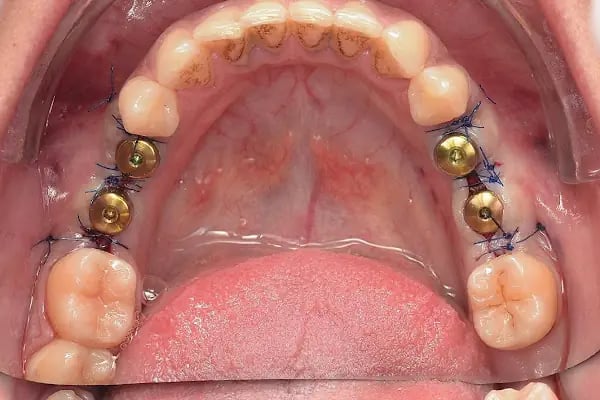 Özel Balıkesir Dentmaks Ağız ve Diş Sağlığı Polikliniği - Hastanesi / invisalign - implant - lamine - Resim 3