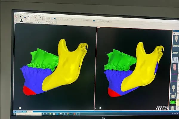 Özel Balıkesir Dentmaks Ağız ve Diş Sağlığı Polikliniği - Hastanesi / invisalign - implant - lamine - Resim 14