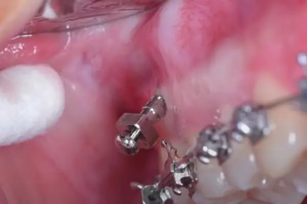 Özel Balıkesir Dentmaks Ağız ve Diş Sağlığı Polikliniği - Hastanesi / invisalign - implant - lamine - Resim 17