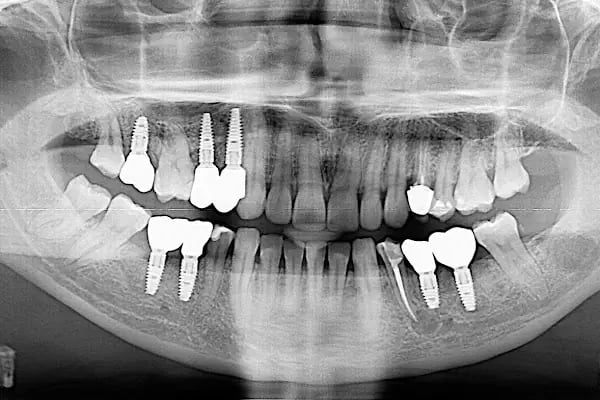 Özel Balıkesir Dentmaks Ağız ve Diş Sağlığı Polikliniği - Hastanesi / invisalign - implant - lamine - Resim 5