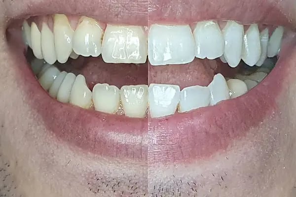Özel Özdemir Dental Klinik Ağız ve Diş Sağlığı Polikliniği - Resim 17