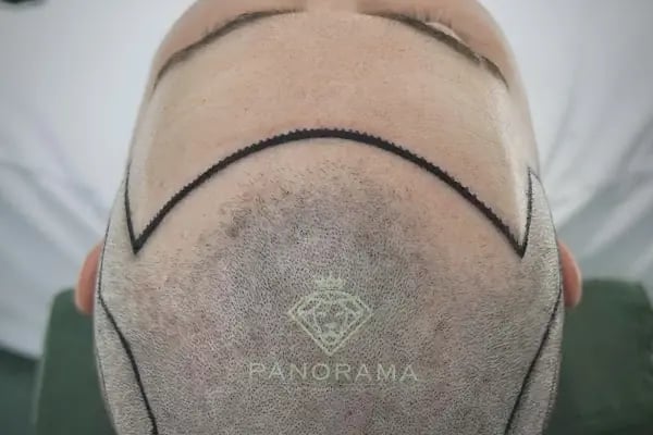 Panorama Hair Turkey - Resim 5