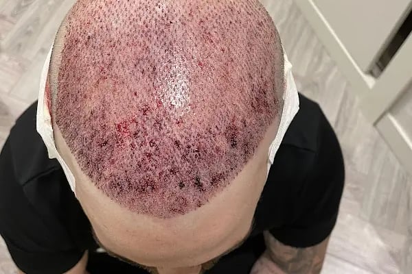Si Hair Transplant in Turkey - Resim 18