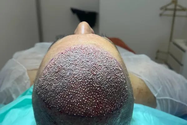 Si Hair Transplant in Turkey - Resim 6