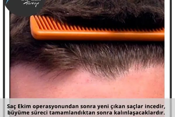 Saç ekimi Türkiye - Resim 15