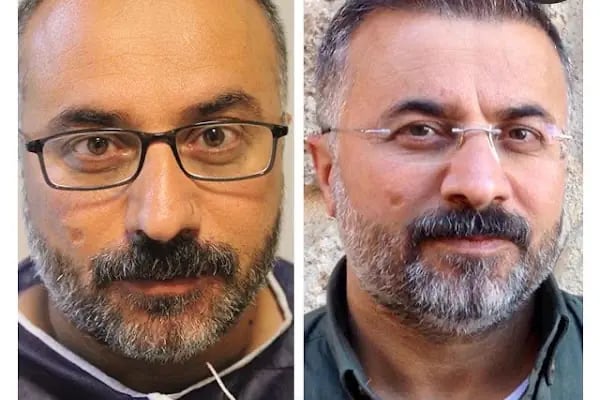 Saç ekimi Türkiye - Resim 8