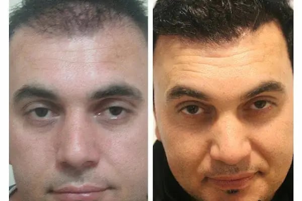 Saç ekimi Türkiye - Resim 14