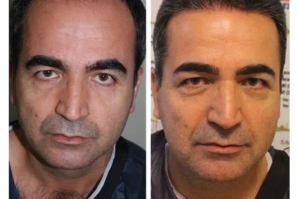 Saç ekimi Türkiye - Resim 10