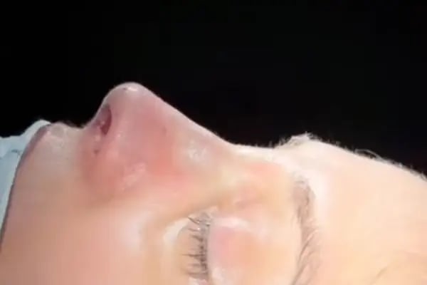 Dr. Çiğdem Özden - Lip Filler | Botox | Thread Lift | Fat Dissolving | Jawline Filler | Fox Eyes | IV Drip &amp; Vitamin - Resim 13