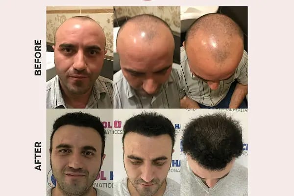 Ekol Saç Ekim Merkezi - Resim 12