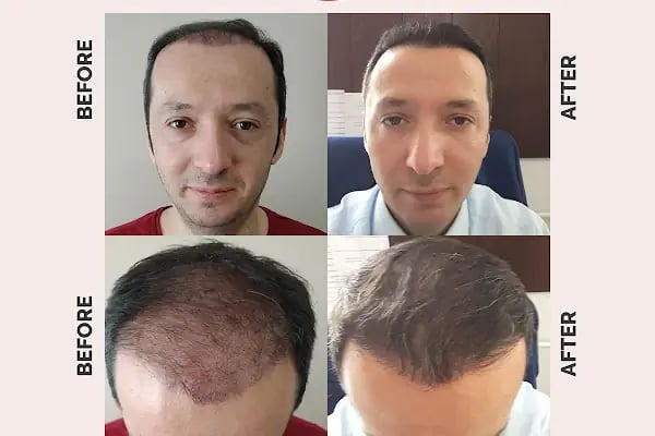 Ekol Saç Ekim Merkezi - Resim 3