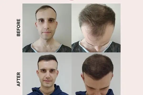 Ekol Saç Ekim Merkezi - Resim 8