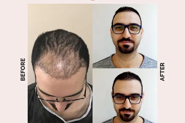 Ekol Saç Ekim Merkezi - Resim 10