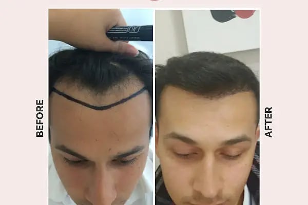 Ekol Saç Ekim Merkezi - Resim 11