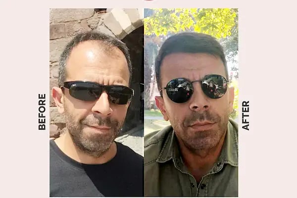 Ekol Saç Ekim Merkezi - Resim 6