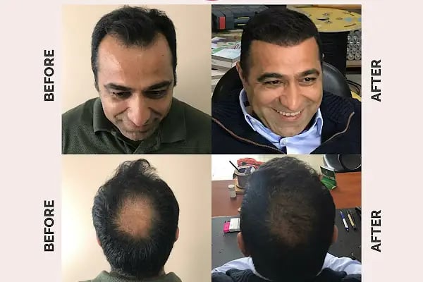 Ekol Saç Ekim Merkezi - Resim 5