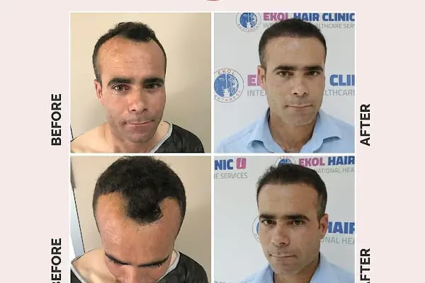 Ekol Saç Ekim Merkezi - Resim 4