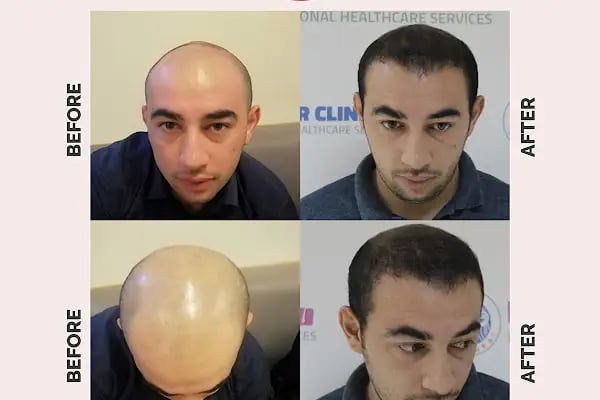 Ekol Saç Ekim Merkezi - Resim 7