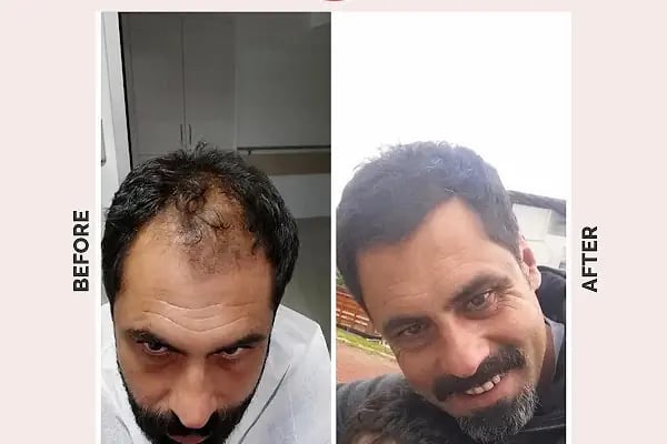 Ekol Saç Ekim Merkezi - Resim 15