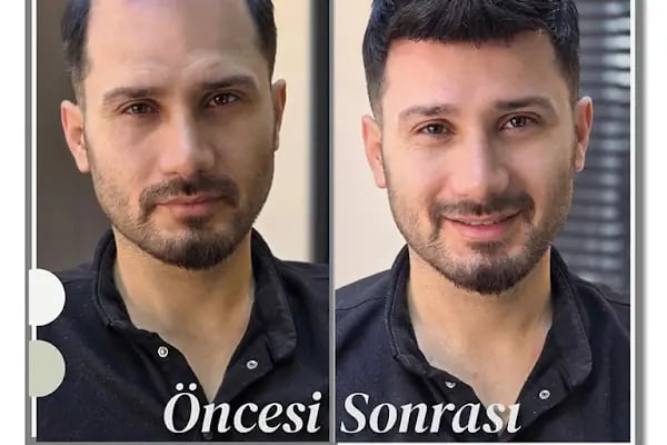 Gold Hair İstanbul - Protez Saç ve Gerçek Saç Merkezi | Real Hair Replacement Center - Resim 2