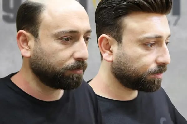 Gold Hair İstanbul - Protez Saç ve Gerçek Saç Merkezi | Real Hair Replacement Center - Resim 17
